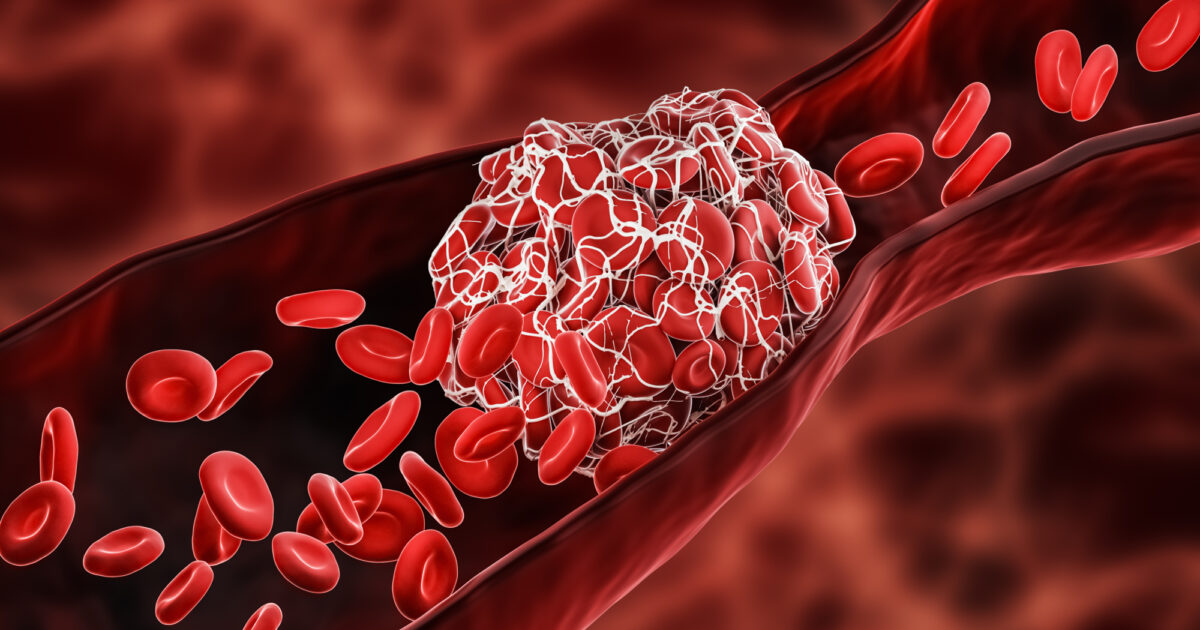 Blood clot symptoms and causes • Heart Research Institute
