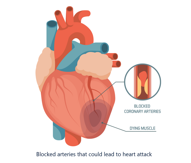 Heart attack hearts 02