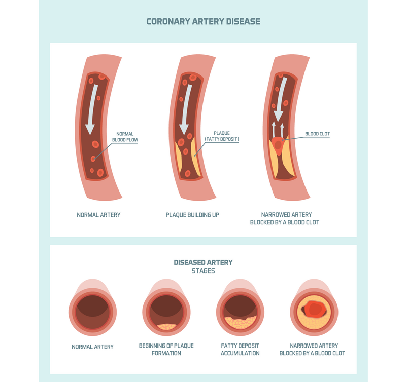 Heart attack Coronary artery disease 01