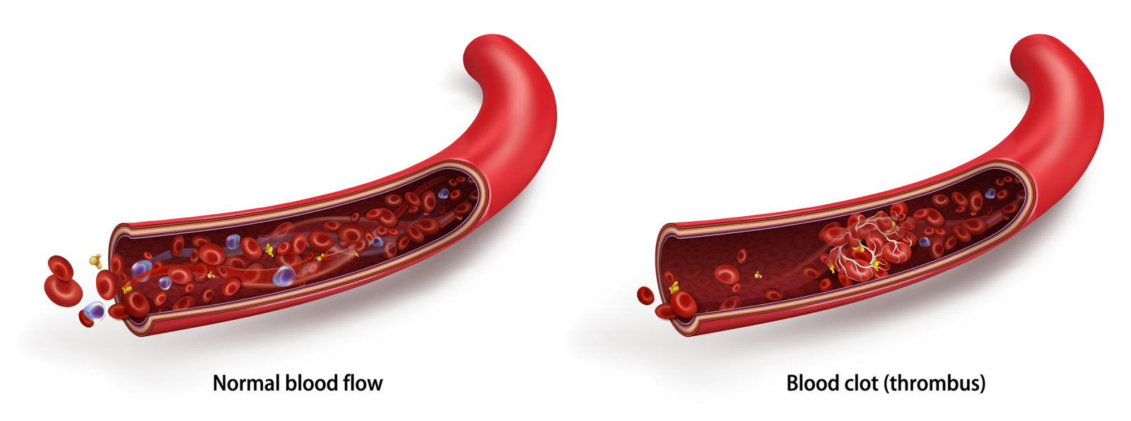 Thrombosis blood flow