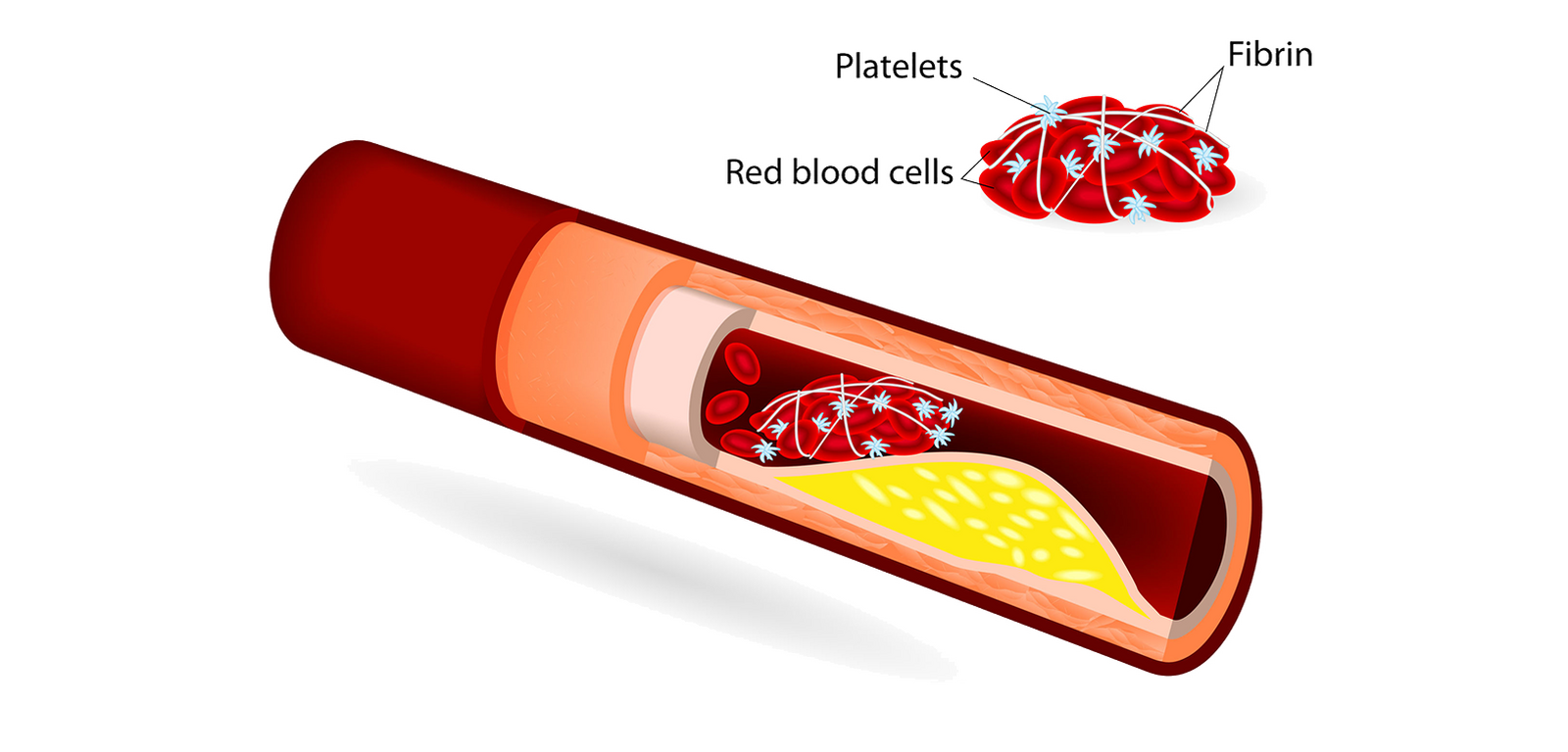 Blood clot 28507812 m3