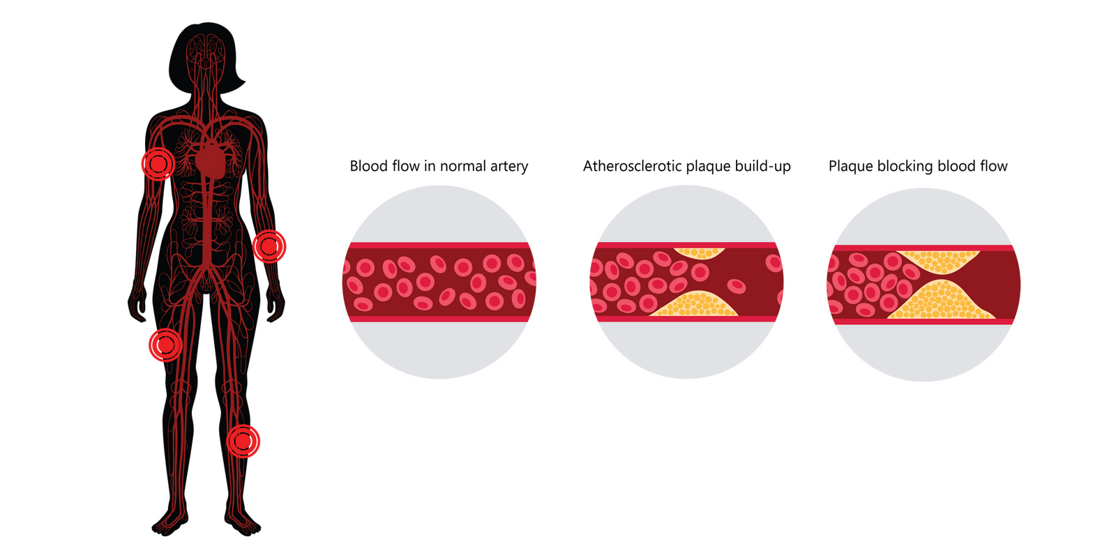 Progression of PAD 01