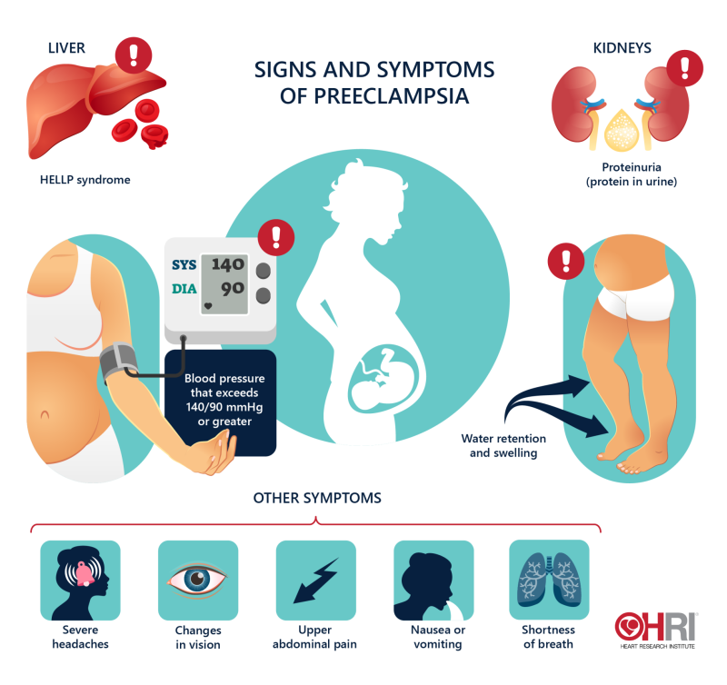 research articles for preeclampsia